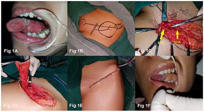 Case Report: Superficial Circumflex Iliac Artery Perforator Flap for Tongue Reconstruction Following the Hemiglossectomy